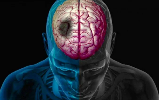 روزانه ۲۰۰ تهرانی دچار سکته مغزی میشوند!